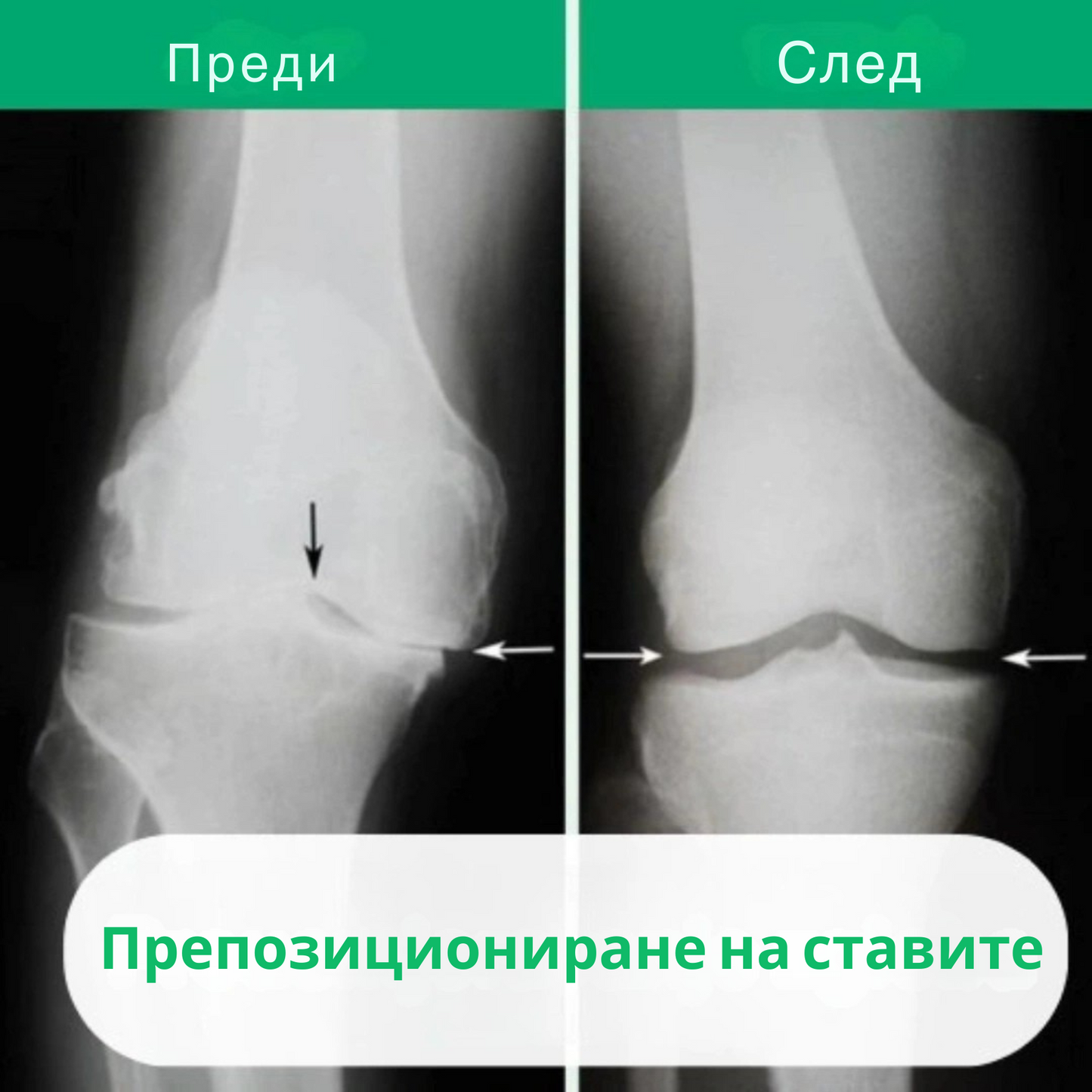 OrthoKnee™ – Дълготрайно облекчение от артрит и болки в ставите