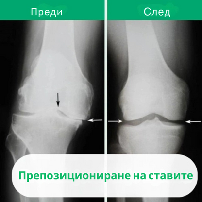 OrthoKnee™ – Дълготрайно облекчение от артрит и болки в ставите